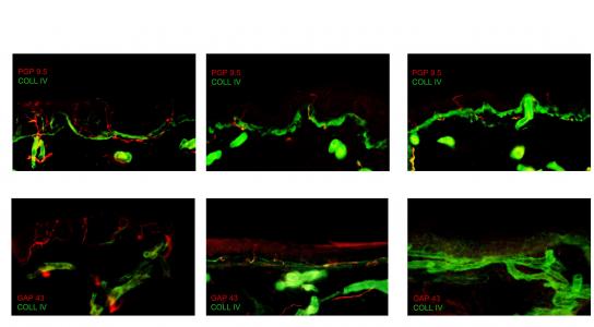 How can we improve the sensitivity of skin biopsy for neuropathic pain?